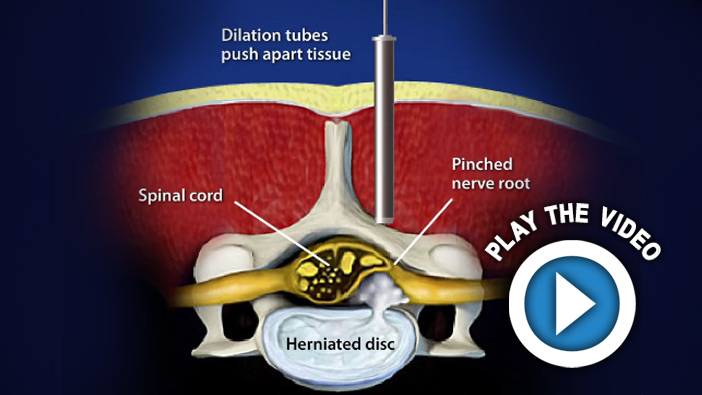 Endoscopic-Assisted Lumbar Interbody Fusion (Transforaminal)