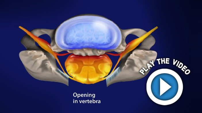 Laminectomy (Cervical) with Fusion